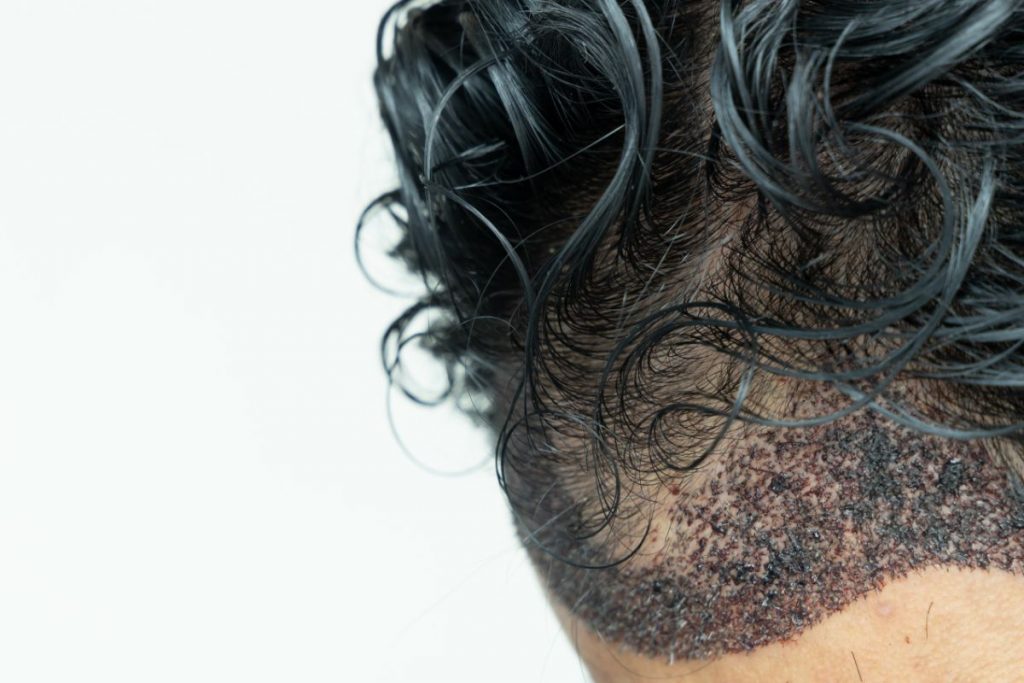 What are the different types of hair transplants?